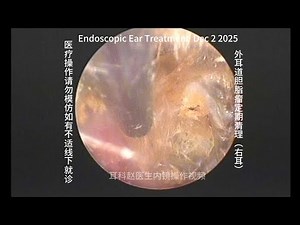 Regular cleaning of cholesteatoma in the external auditory canal 20251202
