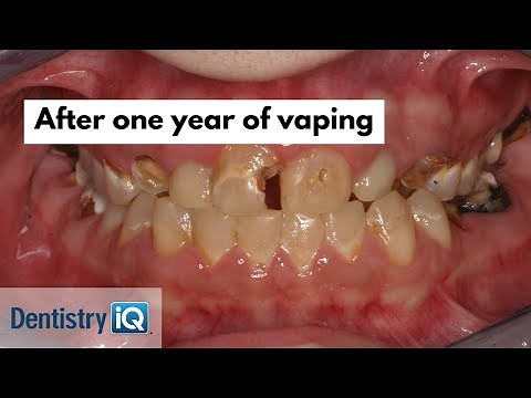 Why vaping destroys your mouth