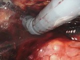 Robotic Retroperitoneal Adrenalectomy for Large Adrenal Lesions Feasibility • Video • MEDtube.net