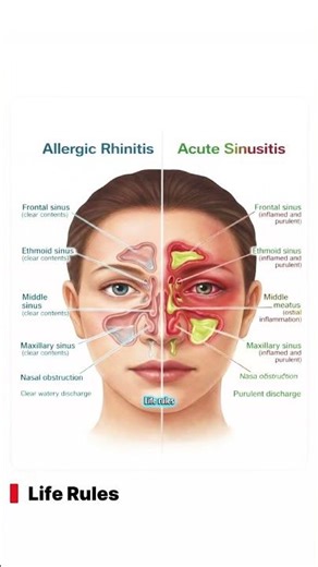 Allergic Rhinitis vs Acute Sinusitis Explained