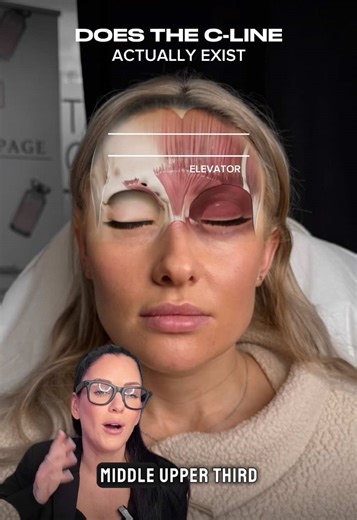 The line of convergence is where technique either works — or completely fails. After 10 years of injecting, this is one of the most misunderstood concepts I teach. The line of convergence is the point where opposing muscle vectors meet. It’s where force, tension, and movement collide. If you inject against it, product spreads unpredictably, shape blunts, and longevity drops. If you inject with it, structure holds and movement stays natural. This is especially critical in areas like the lips, men