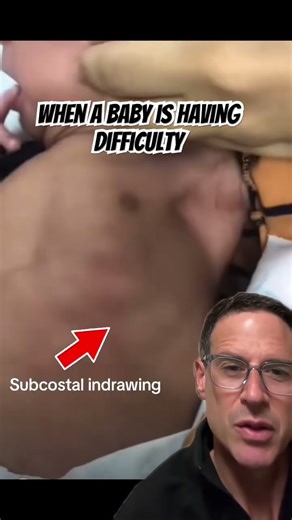 #RSV season is coming. What signs may indicate work of breathing in #brochiolitis ? #pediatrics