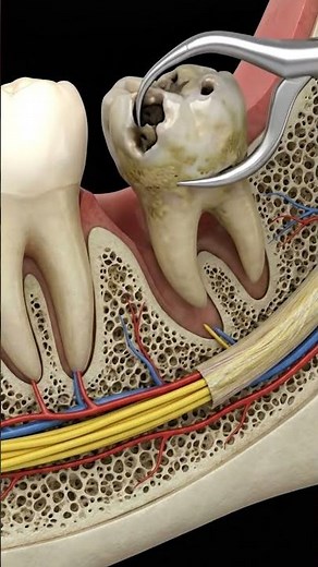 Removing an impacted wisdom tooth isn't just about pulling! 🛑