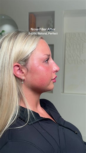 Nose Filler Procedure: A Realistic Guide