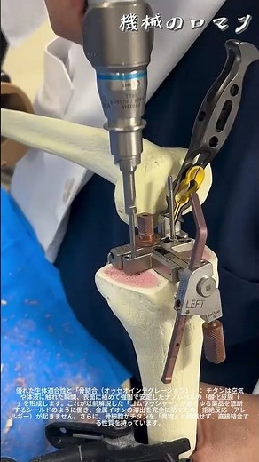 生体と金属が「融合」する究極のバイオメカニクス
