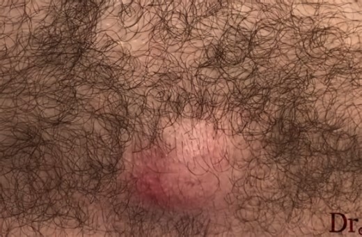 Infected Cyst Drainage on Chest