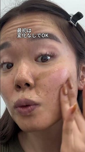 痛くても角栓を取り除きます🎶💖⁡想像以上にごっそり取れたからみんなもやってみて！！⁡ #美容 #スキンケア #垢抜け #ハーブピーリング #毛穴 pr