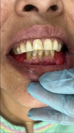 Missing teeth? No worries Removable Partial Dentures = your smile’s “plug & play” upgrade 🦷#viral