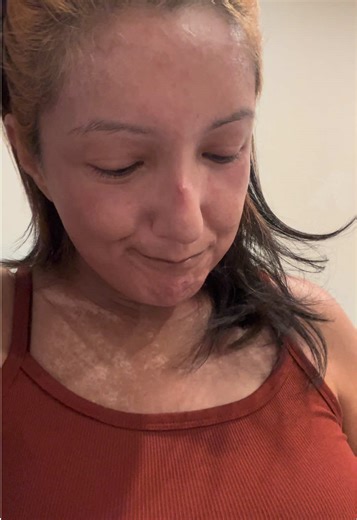 Hello scleroderma warriors! Hope you all had a wonderful Christmas! I have missed you and wanted to check in with y'all real quick hopefully this flare up doesn't knock me down too bad this time! You can see it in my face!! Ugh!! How are you all doing? Sending love to you all! #scleroderma #autoimmunedisease #flareups #sclerodermaawareness #sclerodermalife