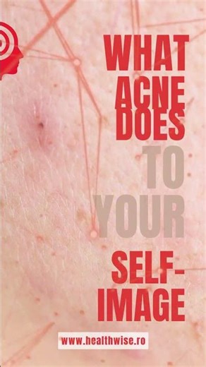 Ce face acneea cu imaginea ta de sine #dermatology #psihologie