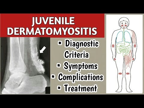 Juvenile Dermatomyositis Symptoms, Diagnostic Criteria, Complications, and Treatment