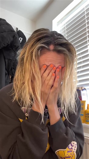 Dealing with Alopecia Areata | Hair Loss Journey