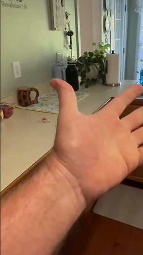 Before the Slac wrist, proximal row carpectomy surgery