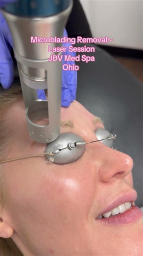 Microblading Removal #lasertattooremoval #brows#mocroblading