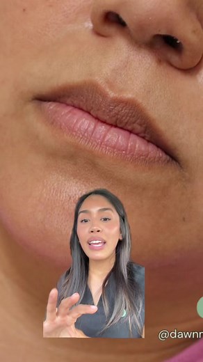 Natural Lip Filler Transformation | Before and After Results