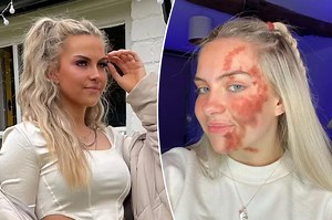 My pimple took over my whole face, doctors don't know what caused it