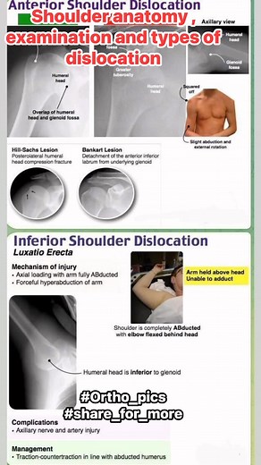 #shoulderanatomy #shoulderdislocation | Ortho-Pics