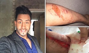 Father suffers horrific leg injuries after contact with common hogweed