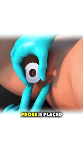 V Tone treatment #3dmedicalanimation #vtone #womenshealth #women #pelvichealth