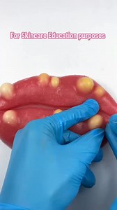 The pimples beneath the Lips👄 are explode. Satisfying?#artificialskin #siliconemodel #education #oddlysatisfying #pimplepopping #relaxingcontent #skincaretips #capcut #howtomakepimples #acnetreatment #asmrtiktoks #fypシ #asmr #viralvideo #pimple #asmrtingles #asmrtriggers #tingles #pimple_popper_asmr #bonniepimplepopperasmr #mochipimplepopping #lips #redlips #sexylips | Bonnie Pimple popperr
