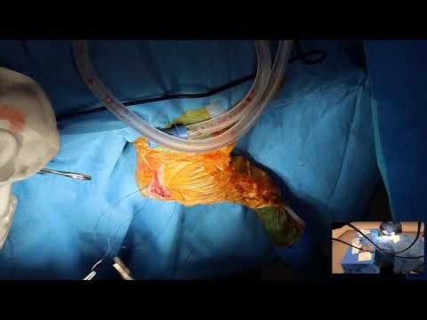 Extra capsular cruciate repair (De Angeles) in a dog