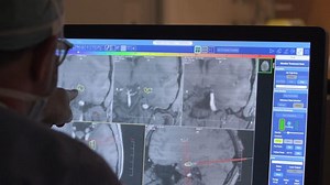 Laser Interstitial Thermal Therapy (LITT) Video: A New Approach to Epilepsy Surgery