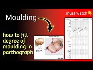 Moulding | Fetal head moulding | labour process| easy explanation in hindi | Nursing guidance