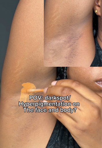 Effective Arbutin Cream for Dark Spots and Hyperpigmentation