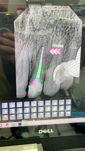 MTA provides a better apical seal than conventional gutta-percha in teeth with apical root resorption and associated periapical lesions #peshawar #dental #dentistry #dentalcare #oralhygiene