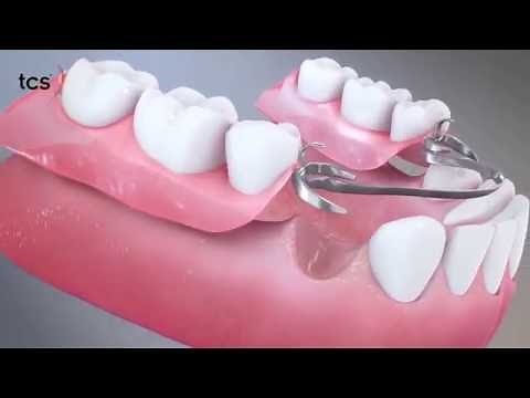 Flexible Partial Dentures Animation Video