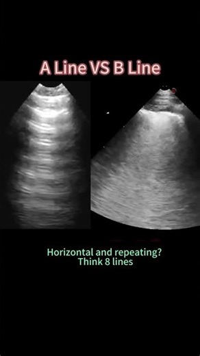 A-Lines vs B-Lines | How to Tell the Difference #ultrasound #sonography #sonographer