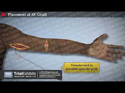 Placement of an AV Graft