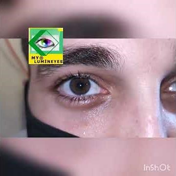 Eye Color Change Surgery Turkey Permanently #permanenteyecolorchange