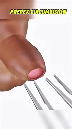 Prepex Circumcision PrePexCircumcision SafeSnipWithPrePex... #Shorts #medical_world_3d
