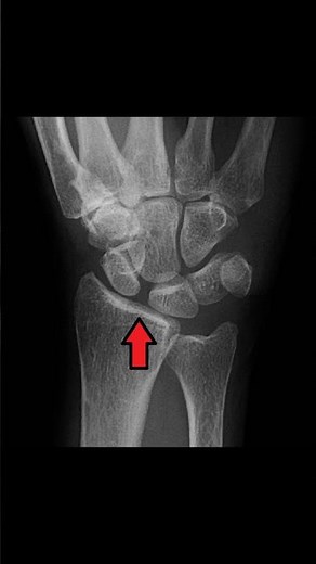 Scapholunate Ligament Explained 🖐️#anatomy #wristpain #meded #physio #ATC #ortho