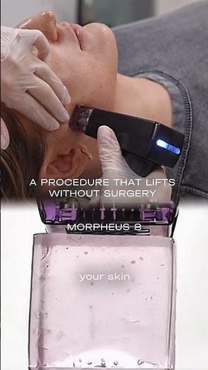 Morpheus 8 RF-lifting is effective, safe and predictable in results🔥 #facelift
