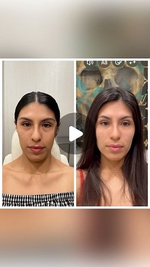 Nicole Smith | California | Botox, Filler, Anti-aging on Instagram: "Tear trough filler using Restylane L. She also had a series of visits to improve her overall aesthetic. Her visits also included enhancing cheeks, smile lines and lips with dermal filler. As well as Dysport for fine lines and wrinkles. . . . @hebeskinhealth . . . #lipfiller #beforeandafter #teartroughfillers"