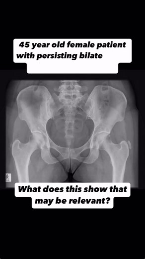 Mehmet Gem | Specialist Hip Physio on Instagram: "What of note can you see? Any questions comment below!⬇️⬇️ *** Check stories / Broadcast channel soon for what it is as I’ll be sharing the answer soon** ♻️ Share the post ⁣⁣⁣⁣⁣⁣⁣⁣⁣⁣⁣⁣⁣⁣⁣⁣⁣⁣⁣⁣⁣⁣⁣⁣⁣⁣⁣⁣⁣⁣ 🖊Comment below ⁣⁣⁣⁣⁣⁣⁣⁣⁣⁣⁣⁣⁣⁣⁣⁣⁣⁣⁣⁣⁣⁣⁣⁣⁣⁣⁣⁣⁣ Follow @the.hip.physio 🚶🚶🏽🚶🏾‍♀️ #medstudent #medicalschool"