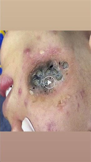 Watch These Satisfying Cyst Popping Clips 58
