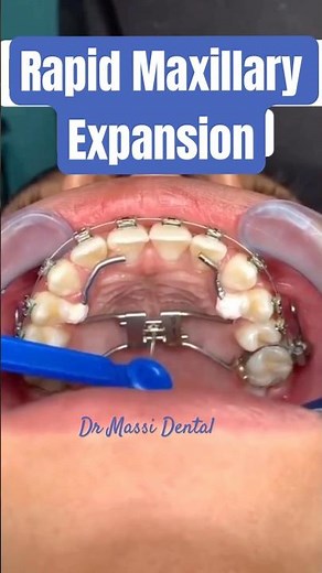 Rapid Maxillary Expansion Orthodontic Devices
