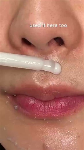 How I Cleared Bumpy Skin Around My Mouth in 7 Days ✨