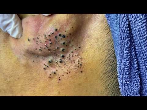 Blackhead Removal With Sac Dep Spa @438