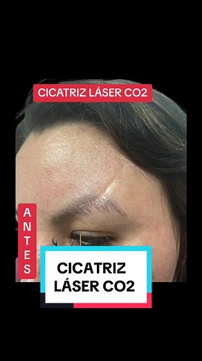 Cicatrices, Laser Co2 tratamiento #laserco2 #laserco2fraccionado #laser #laserhairremoval #cicatrices #cicatriz #cicatrizqueloide #piel #pielbonita #pielsanaybonita #lima