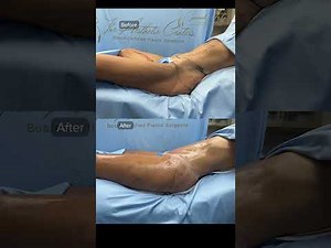 Lower Body Lift and Thigh Reduction