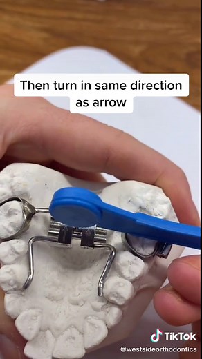 This is how you turn an expander which is done once a day!! This cool device is used to widen the jaw 🦷 #expander#orthodontics#turningexpander#fyp