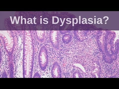 What is Dysplasia? - Pathology mini tutorial