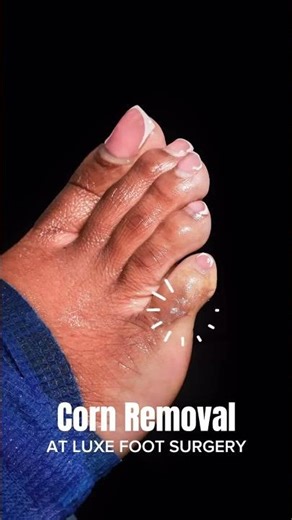 CORN REMOVAL SURGERY | before and after