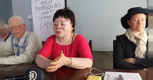 Cameroon's albinos threatened by magic and superstition | Africanews