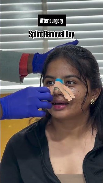 Rhinoplasty (before and after surgery)