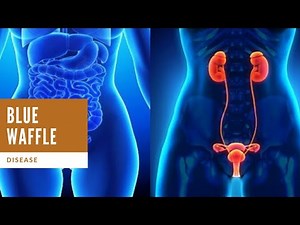 Blue waffle disease: Is it a real STD ?